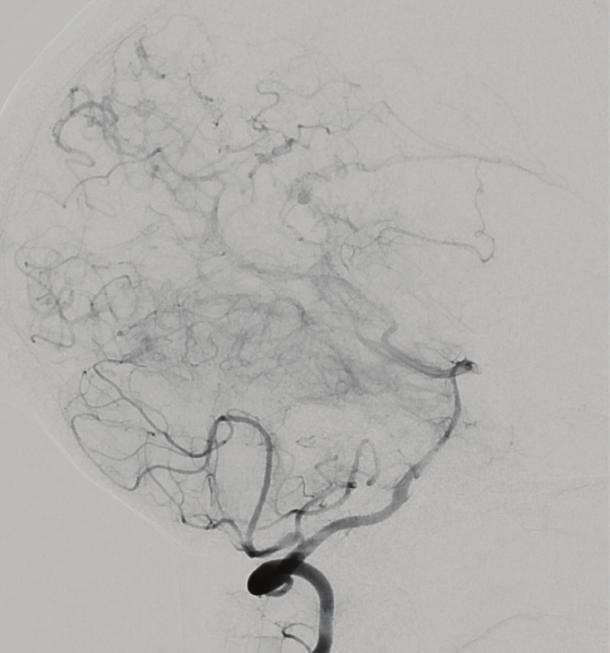 adjacent collateral vessels. aneurysm in the wall of the atrium of the right lateral ventricle supplied by tortuous vessels arising from the posterior choroidal artery.