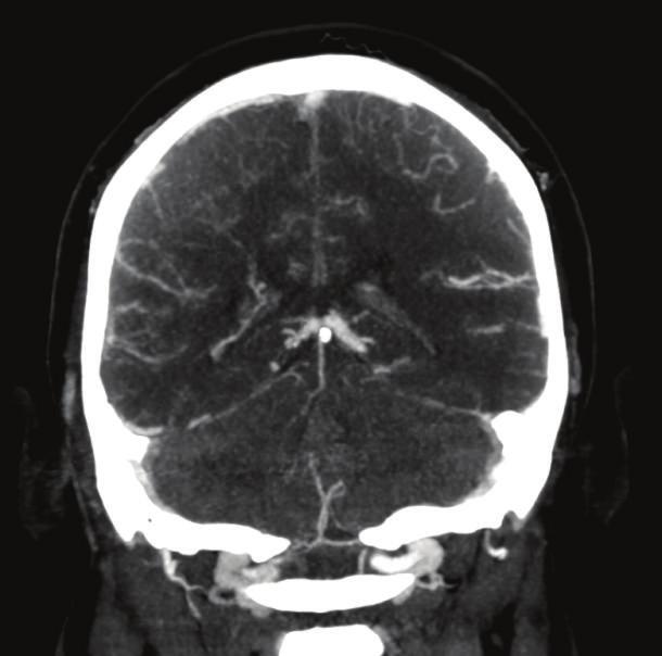 Postoperative CT angiography demonstrated reduced intraventricular hemorrhage and no evidence of residual aneurysm (Figures 2(c) 2(e)). The patient was discharged home on postoperative day three. 3.
