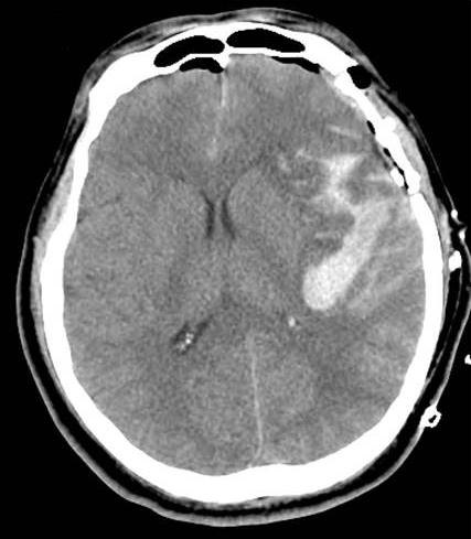 decompressive craniectomy. The mean removal ratio of hematoma (63.2%) was higher than in Group A (33.4%), however, statistical difference was not observed (p = 0.115).