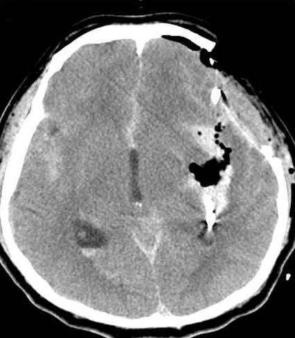 Case 2 A 42-year-old male was transferred to emergency room presenting with semicomatous consciousness (Hunt-Hess 5).
