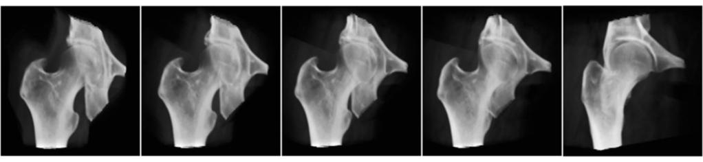 3: Sequentially rotated multiplanar reformats of right hip to