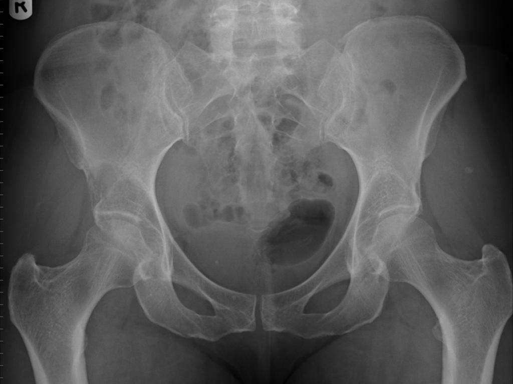 Fig. 10: Lucent lesion in right acetabular