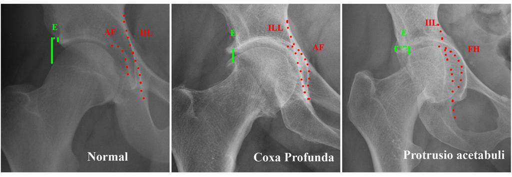 Fig. 12: Right AP hip projections of normal, coxa profunda and protrusion acetabuli