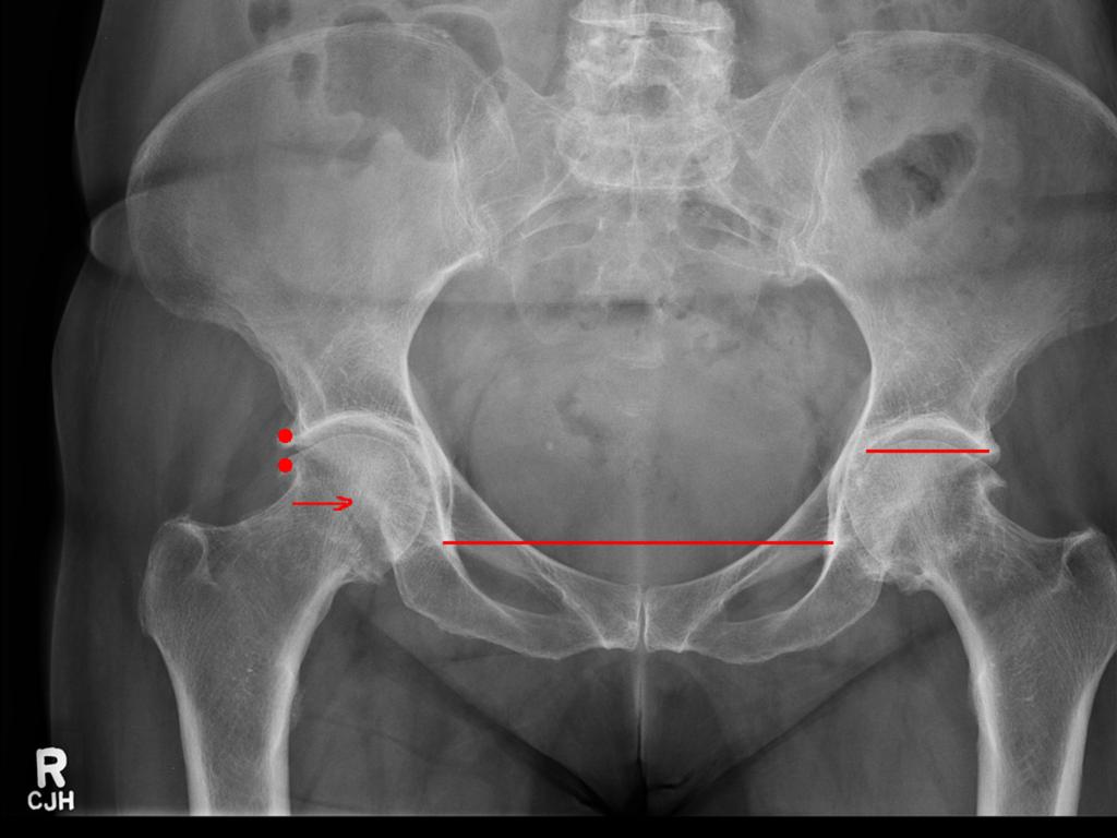 Fig. 14: Pincer impingement. Posterior wall sign positive as posterior wall lies medial to centre of femoral head(arrow). Excessive acetabular coverage (red dots).