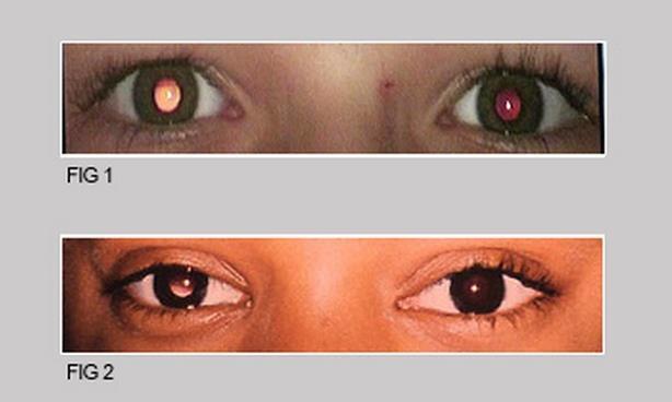 Look for: Poor red reflex or Different in each eye (shows