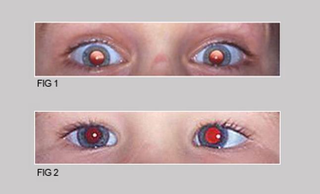 Longsighted & Esotropia Top (moderate hyperopia): bright, lighter red crescents at top of the pupil.