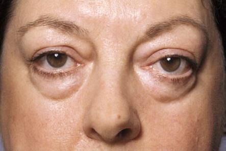 Dermatochalasis: laxity and redundancy of eyelid skin secondary to aging. (OLDER PATIENTS).