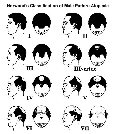 Best way to evaluate a 35 year-old man for hair transplantation: Wait until 45 years of age and re-evaluate Wet hair Assess hair loss pattern of
