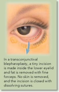 Photo of a transconjunctival approach to lower bleph. Patient has pain in the eye with irritation post-op.