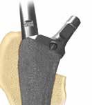 Attach the proximal/distal inserter handle strike plate, tightening until a click is felt and heard.