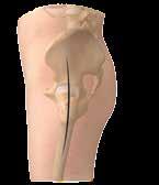 The use of medial and/or lateral strut grafts may be necessary to