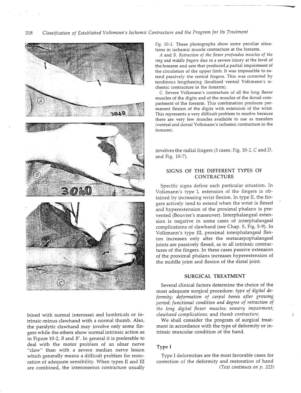 318 Classification of Established Volkmann" s Ischemic Contracture and the Program for Its Treatment Fig. 10-3.