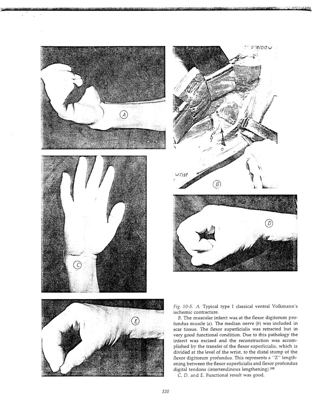 Fig. 10-5. A. Typical type I classical ventral Volkmann s ischemic contracture. B. The muscular infarct was at the flexor digitorum profundus muscle (a). The median nerve (b) was included scar tissue.