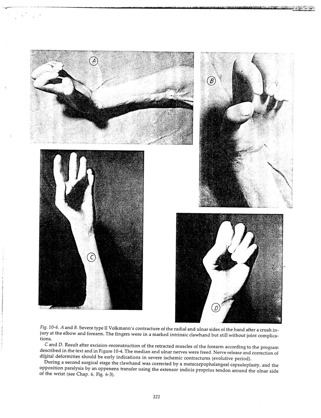 Fig. 10-6. A and B. Severe type II Volkmann s contracture of the radial and ulnar sides of the hand after a crush injury at the elbow and forearm.