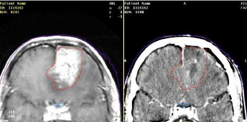 MR CT On the left is an MR image of a patient with a brain tumour. The target has been outlined and the result was superimposed on the patient s CT scan.