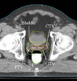 MALE PELVIC CONTOURING Contours for different volumes have been drawn on this CT slice for a prostate treatment plan: GTV CTV PTV