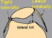 border of the patella superiorly to assess the tightness of the lateral