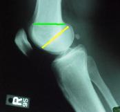 patellar subluxation or dislocation knee flexion tibial external rotation valgus