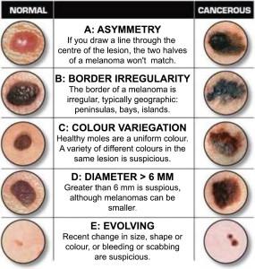 Melanoma Graphic Warning Medical names: cutaneous melanoma (melanoma of skin), intraocular melanoma (melanoma of eye) Affects mainly skin, can also affect eye, vagina or