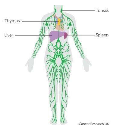 Melanoma has spread to regional lymph nodes, a part of the lymphatic system (portion of immune system used to drain fluids from tissues) Divided into IIIa, b, c,