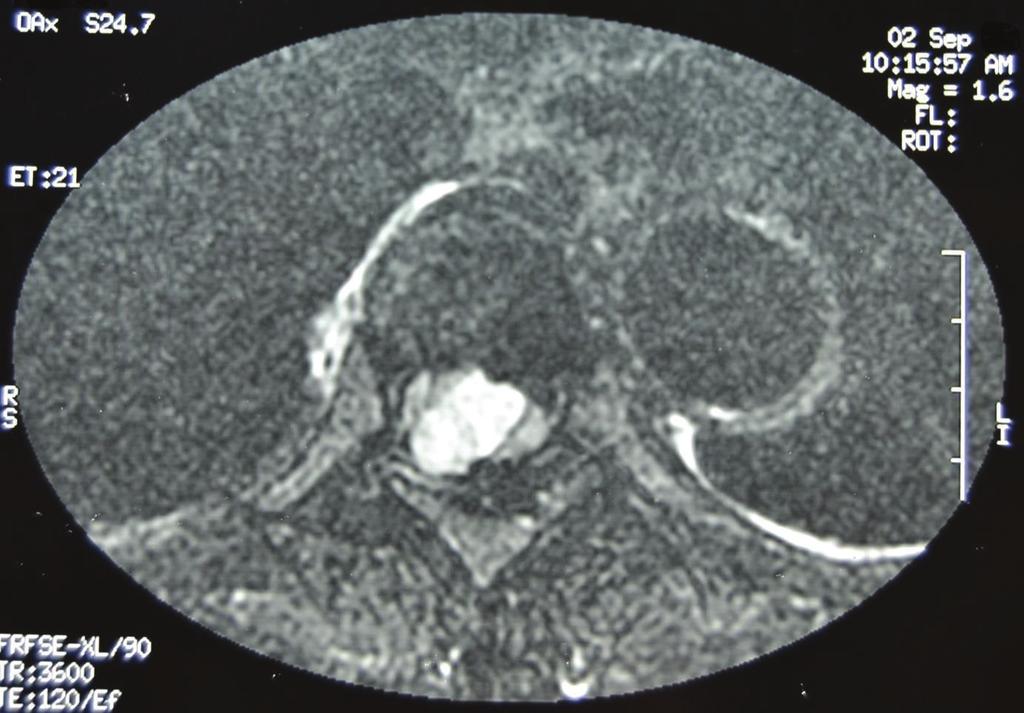 2 (c) Figure 1: Preoperative axial and sagittal T1-weighted and sagittal (c) T2-weighted MR images through the thoracic spine showing a T1 hypointense, T2 hyperintense, extradural