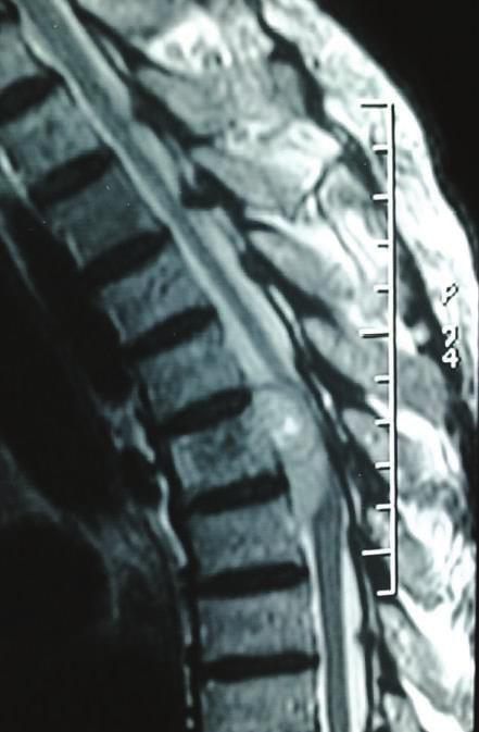 MRI showed a local relapse of the disease with mainly anterior lateral progression including T5 vertebral body and posterior mediastinum (Figure 6).