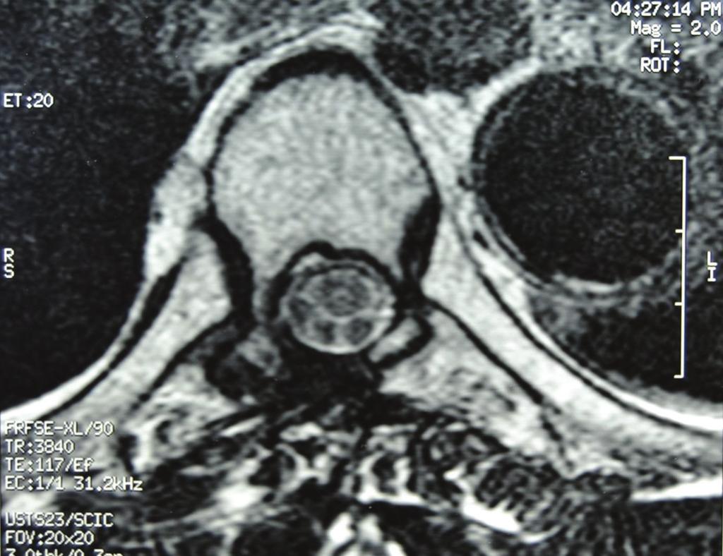 3 Figure 6: Recurrence sagittal T1-weighted and T2-weighted MR images showing an important space occupying mass with spinal cord compression, T5 vertebral body involvement, and large posterior
