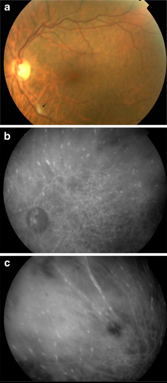 J Ophthal Inflamm Infect (2012) 2:199 203 201 Results Fig. 2 Patient 4. a Fundus photograph of the left eye shows a cottonwool spot (black arrow).