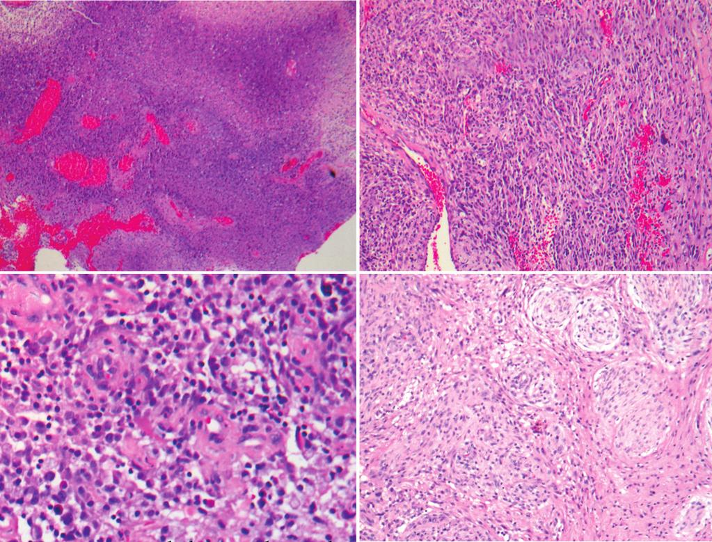 Tumor that these tumors infiltrated the brain to adopt or co-opt existing vessels in response to anti-angiogenic treatment (Figure 3). 15 A Paez-Ribes, et al.