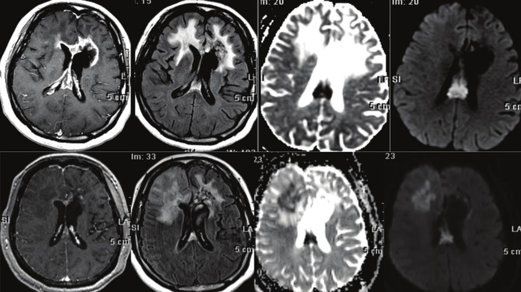 T1 GD Flair ADC DWI Recurrent left frontal GBM Left frontal GBM after 6 months of Bevacizumab Figure 4 This patient presented with a recurrent left frontal GBM with enhancing tumor and increased