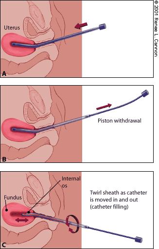Endometrial Sampling Sufficient material obtained in about 90.