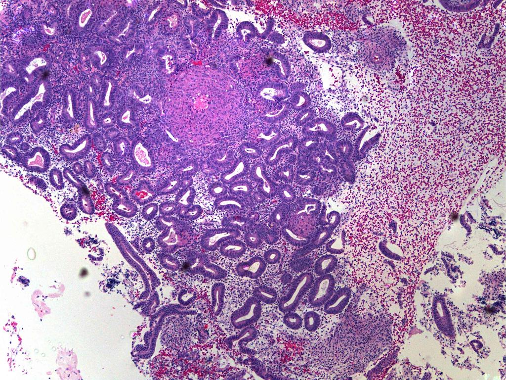 Example: Complex Hyperplasia WHO System: - Complex hyperplasia (with squamous morules) EIN System: - Proliferative endometrium, with gland crowding and squamous morular metaplasia.