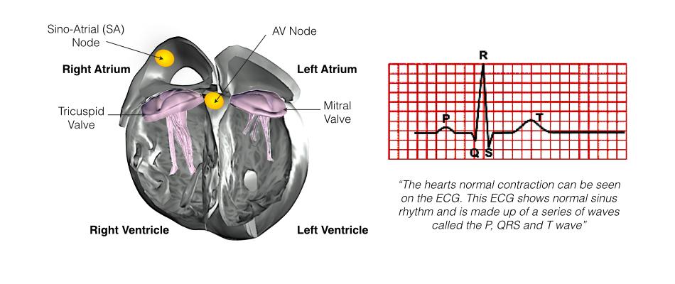 Melbourne Heart Rhythm ICD Implantation Patient Information The Heart The heart is a pump responsible for maintaining blood supply to the body. It has four chambers.
