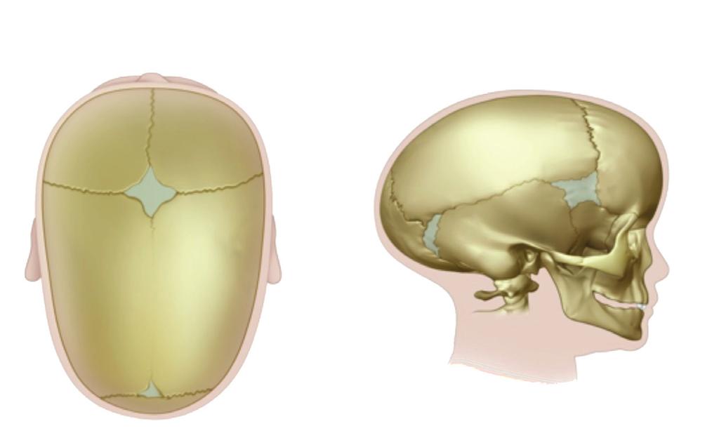 SAGITTAL SYNOSTOSIS Sagittal synostosis, also known as scaphocephaly, is the most