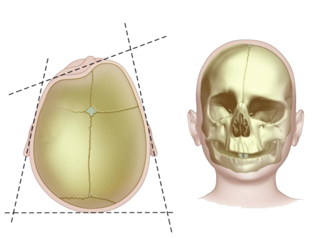 UNILATERAL CORONAL SYNOSTOSIS Unilateral coronal synostosis is also known as anterior plagiocephaly.