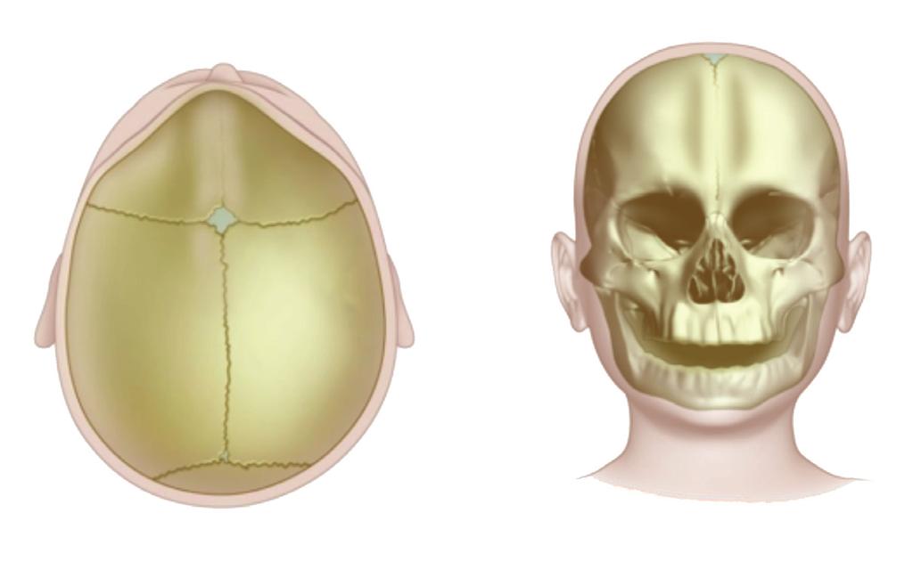 METOPIC SYNOSTOSIS Metopic synostosis, also known as trigonocephaly, is a less common form of craniosynostosis; however, metopic ridging is very