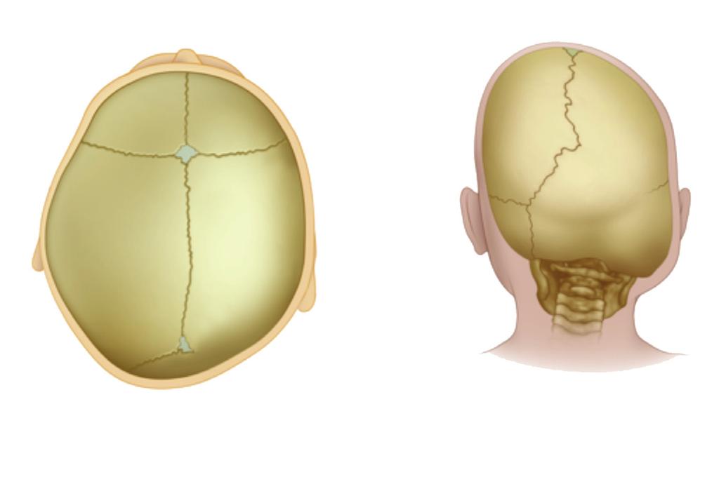 LAMBDOID SYNOSTOSIS Lambdoid synostosis is a much less common form of synostosis and the less common cause of posterior plagiocephaly.