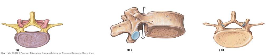 Typical lumbar vertebra Articular es articular Transverse Pedicle body Transverse articular Spinous Inferior articular view arch body Inferior