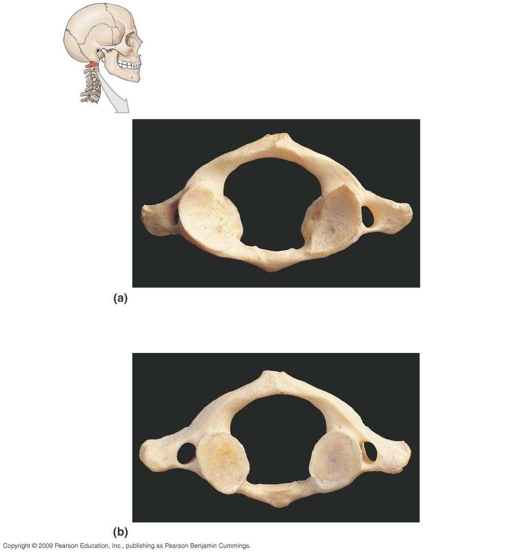 st cervical vertebra (C) or atlas articular facet articular Atlas, superior view