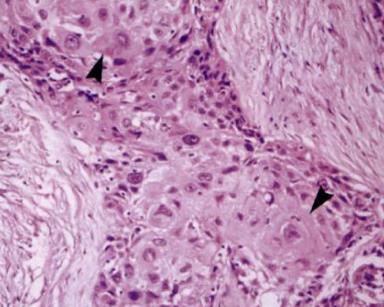 Squamous vs Non-Squamous Adenocarcinoma 1,2 Squamous 1-3 H-E stain X150 H-E stain X150 Presence of glands and papillary