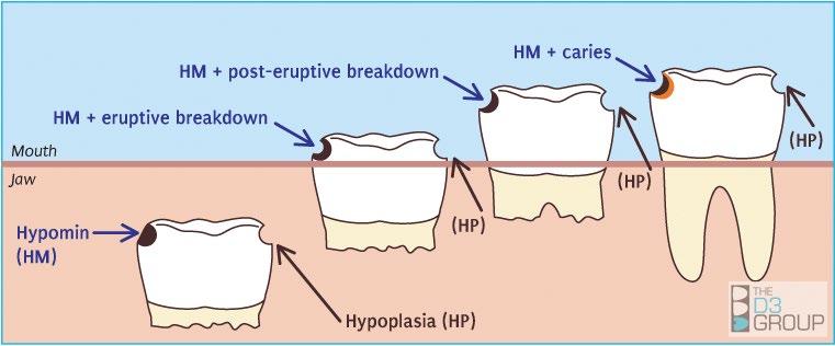 What are the important things to look for when diagnosing Molar Hypomin? Prof.