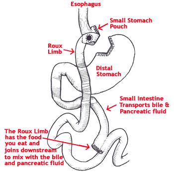 Laparoscopic Roux-en-Y Gastric Bypass The Roux-en-Y Gastric Bypass performed laparoscopically (minimally invasive surgery) in most cases through six small incisions.
