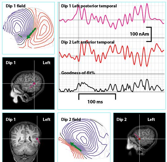 partial seizures). Ictal MEG revealed a 66-Hz ictal onset signal.