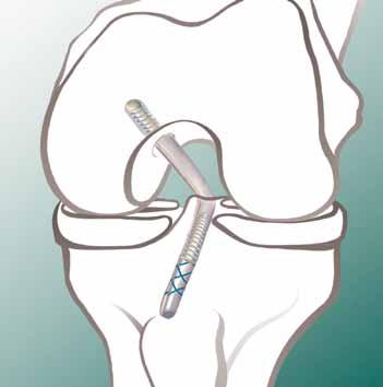 Transtibial PCL Reconstruction Surgical