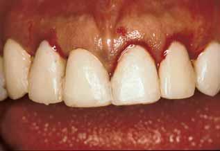 the placement of the final restorations. Special attention should be given to the development of the proper emergence profile of the provisional restorations buccally, lingually and interproximally.