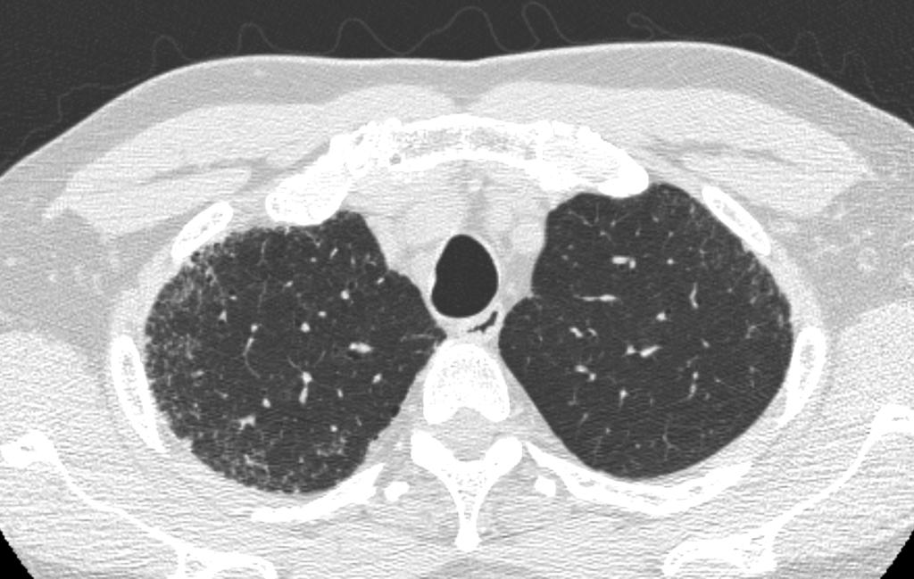 What additional testing would you perform next in this patient? 1. Bronchoalveolar lavage (BAL) 2.