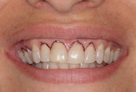 Figure 4: Outlining the desired gingival margins, prior