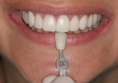 Figure 10: Detailed information helps the laboratory to translate clinical results to the porcelain restorations.