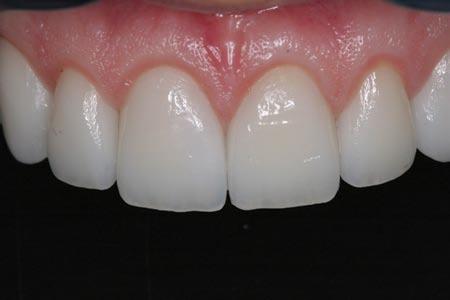 The patient s teeth were prepared for veneers and a crown with mild soft tissue reshaping, to fine-tune our previous treatment.