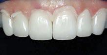 Conclusions The use of a hard/soft tissue laser is a wonderful adjunctive tool for cosmetic and restorative dentistry.